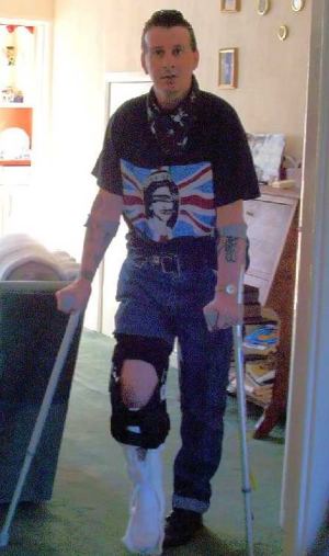 Me on crutches with a broken knee